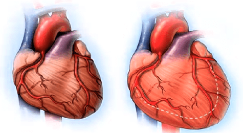 insuficiencia cardiaca