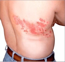 herpes zoster